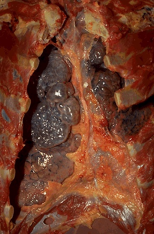 The chest cavity is opened at autopsy to reveal numerous large bullae apparent on the surface of the lungs in a patient dying with emphysema.  Bullae are large dilated airspaces that bulge out from beneath the pleura.  Emphysema is characterized by a loss of lung parenchyma by destruction of alveoli so that there is permanent dilation of airspaces.