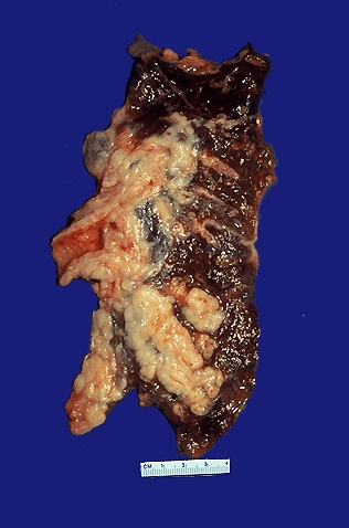 Arising centrally in this lung and spreading extensively is a small cell anaplastic (oat cell) carcinoma. The cut surface of this tumor has a soft, lobulated, white to tan appearance. The tumor seen here has caused obstruction of the main bronchus to left lung so that the distal lung is collapsed. Oat cell carcinomas are very aggressive and often metastasize widely before the primary tumor mass in the lung reaches a large size.