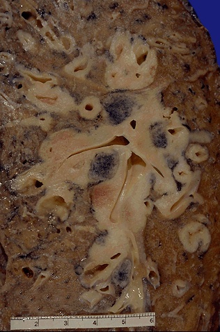 Here is an oat cell carcinoma which is spreading along the bronchi. The speckled black rounded areas represent hilar lymph nodes with metastatic carcinoma. These neoplasms are more amenable to chemotherapy than radiation therapy or surgery, but the prognosis is still poor. Oat cell carcinomas occur almost exclusively in smokers.  Malignant neoplasms are also characterized by their tendency to invade surrounding tissues.