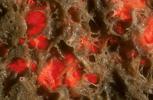 Emphysema, representating a late 20th century version of The Masque of the Red Death in Edgar Allen Poe's short story, is shown here. Note the loss of lung parenchyma with irregular holes. It should be remembered that deaths from emphysema, as well as lung cancer, have increased greatly over the past few decades because of smoking.