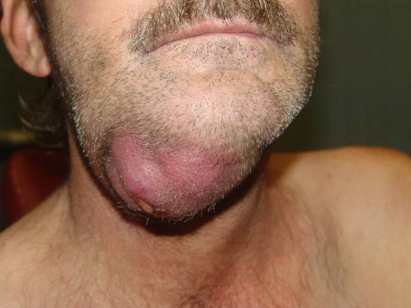 This smoker has tongue cancer and it's spread to his neck.