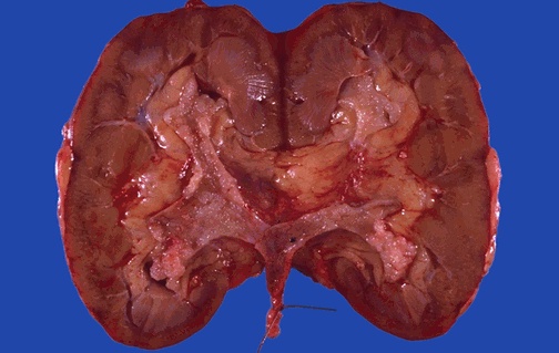 The pelvis of the kidney is shown here with a urothelial carcinoma. These carcinomas are more likely to occur in a smoker. These carcinomas also have a tendency to recur and to be multiple.