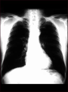 Bronchial cancer in the lungs