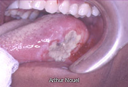A smokers mouth with cancer.