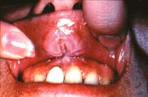 Mouth cancer from smokeless tobacco.